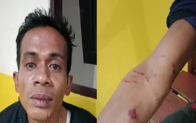 Korban Fandro Tuhepary (38) yang dianiaya sang majikan dengan sejumlah luka di bagian tangan karena digigit anjing piaraan sang majiakan. Korban dipukul hingga jatuh ke lantai (Foto : FB Donny Tuhepary)