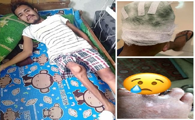 Irsan Makatita (25) Mahasiswa  Fakutas Ekonomi,Universitas Pattimura, Ambon, yang terserang penyakit ‘Buerger Disease’. Tampak kakinya yang mengecil disertai jari-jari kaki kanan yang membusuk.