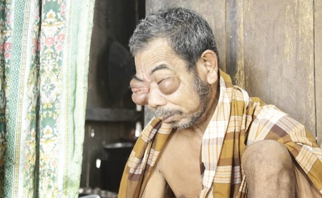 La Mauria, warga Dusun Ulusadar, Desa Waesala, Kecamatan Huamual Belakang, Kabupaten Seram Bagian Barat (SBB) yang mengidap penyakit mata dengan ciri membengkaknya dua kelopak matanya (FOTO : Fecebook H. Hambra Samal)